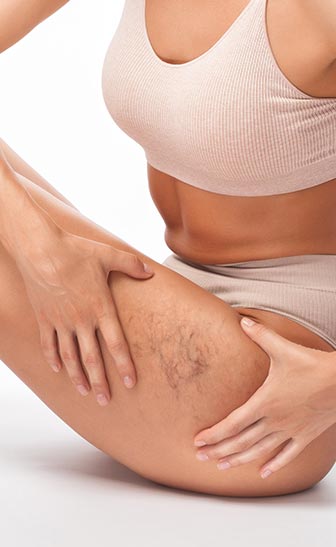 Sclerotherapy Spider Vein Removal